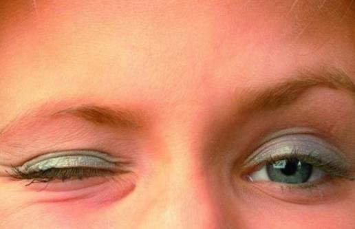 眼皮跳可能是身體出了問題 病理性眼皮跳一定要當(dāng)心
