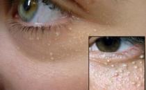 臉上脂肪粒的形成因素 脂肪粒最有效的去除方法