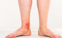 淤血體質(zhì)調(diào)理食物有效祛瘀 保持心情舒暢作息規(guī)律