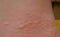 ?渾身癢是怎么回事,老人渾身起疙瘩渾身癢是怎么回事